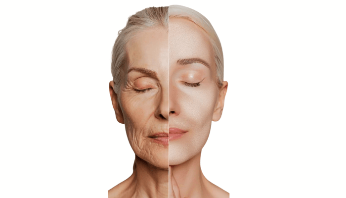 Facelift 