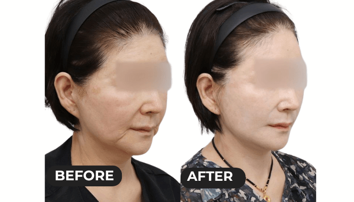 Facelift Thailand