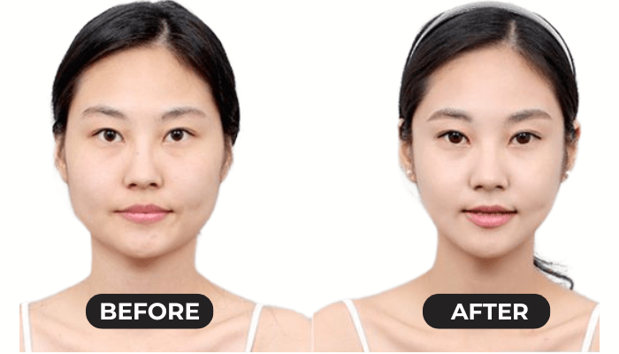 facelift