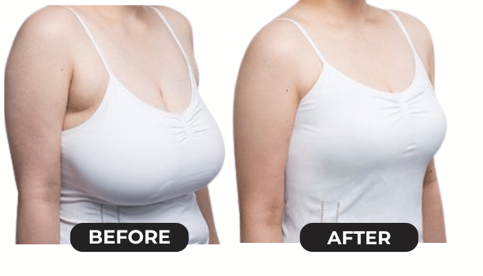 Breastlift