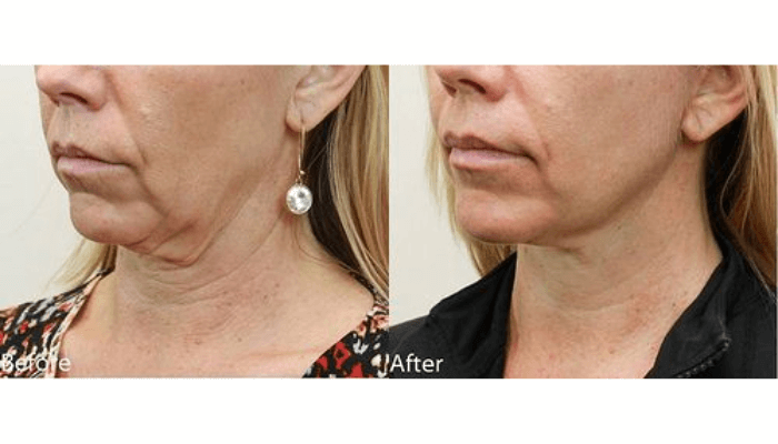 Facelift
