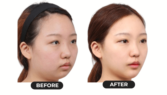 Facelift 