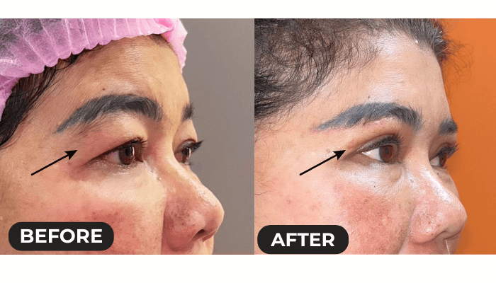 eyelid