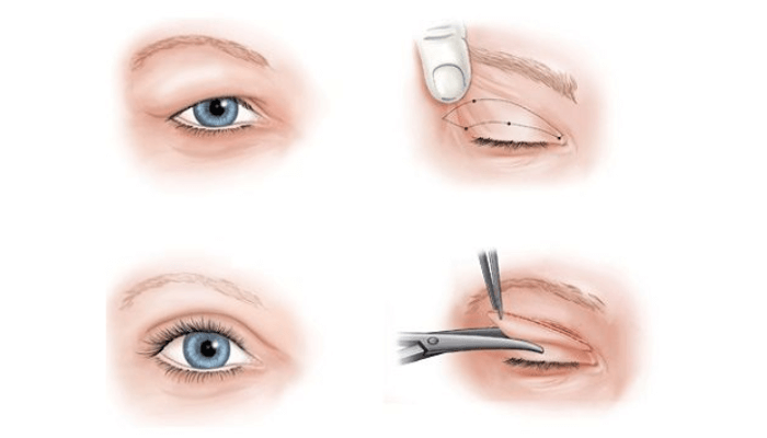op eyelid